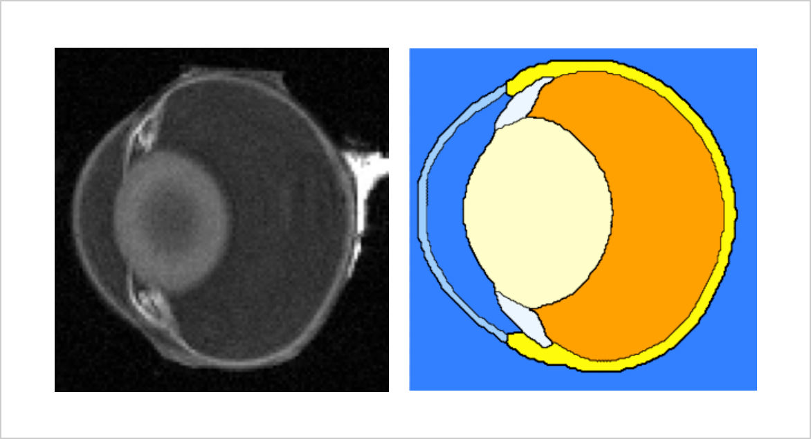 図2. 眼部MRI画像(左図)と高精細眼部モデル(右図)